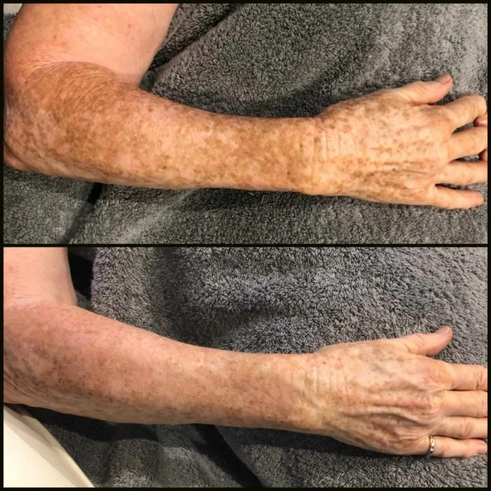 Sun Spots and Sun Damage Treated With BBL