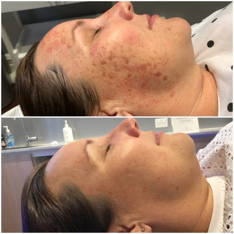Pigmentation Targeted With BBL