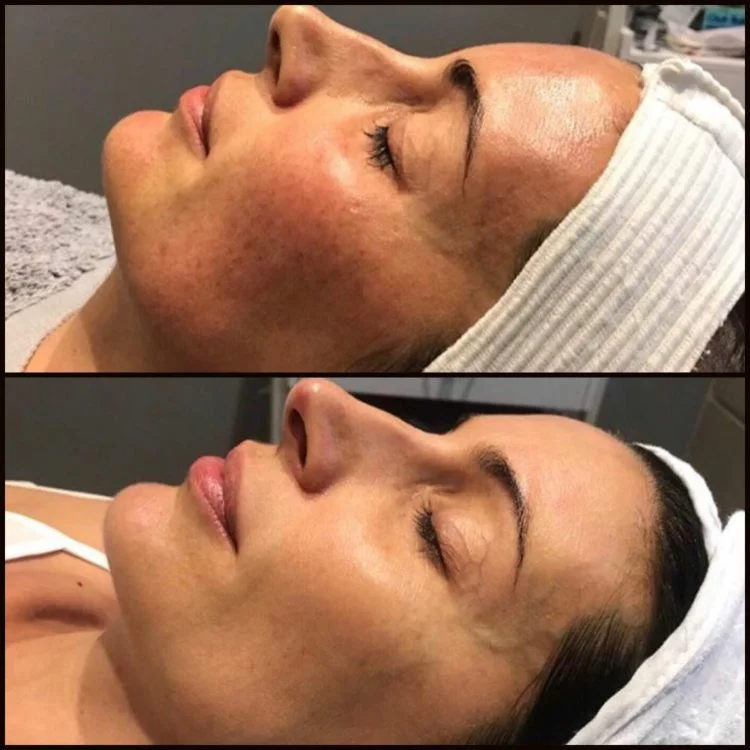 Pigmentation Targeted With BBL