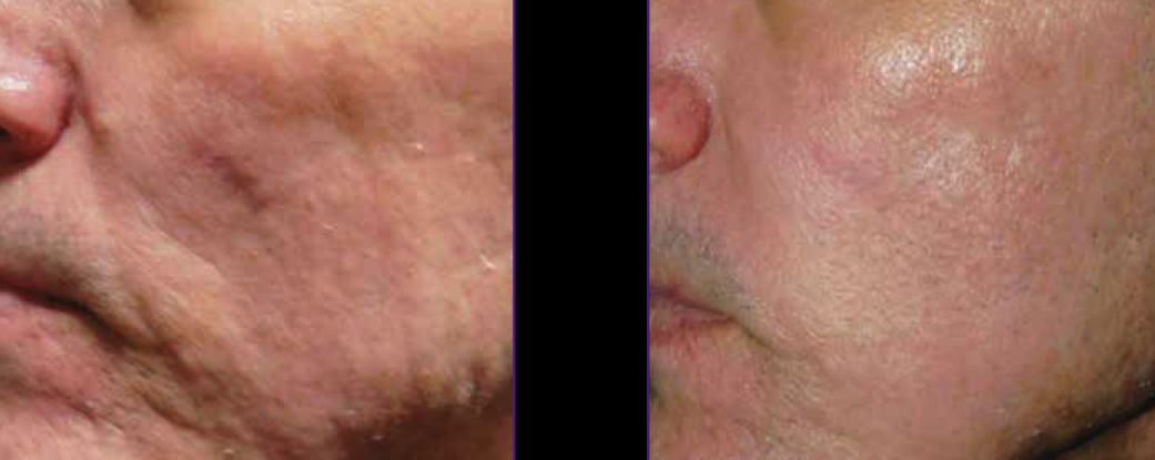 Scarring Treated With Intensif - Radio Frequency Microneedling