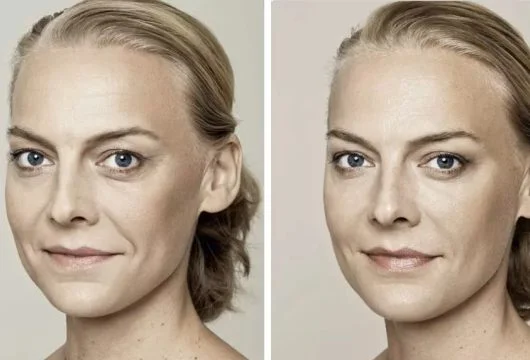 Skin booster B and A 1.jpg