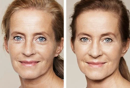 Skin booster B and A 3.jpg