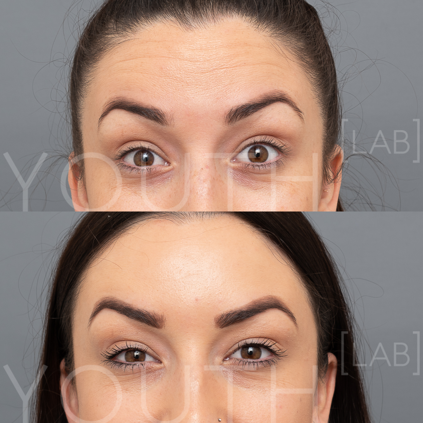 TASH K - anti-wrinkle Forehead B&A.jpg