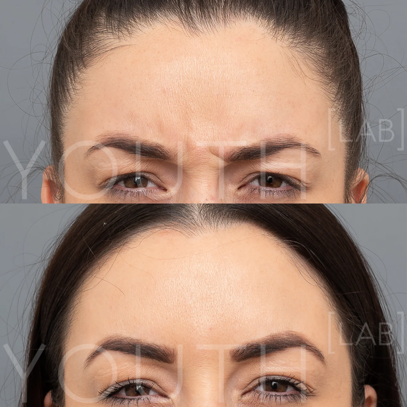 TASH K - anti-wrinkle Frown B&A.jpg