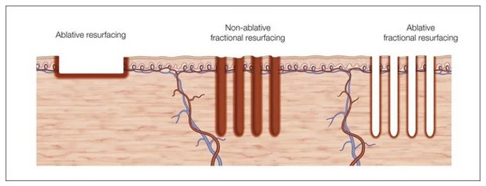 fractionated-and-non-fractionated-lasers-work.jpg