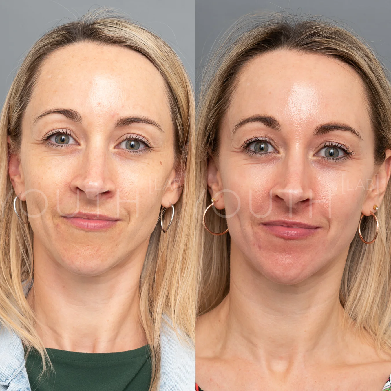 SD DERMAMELAN B&A 2.jpg
