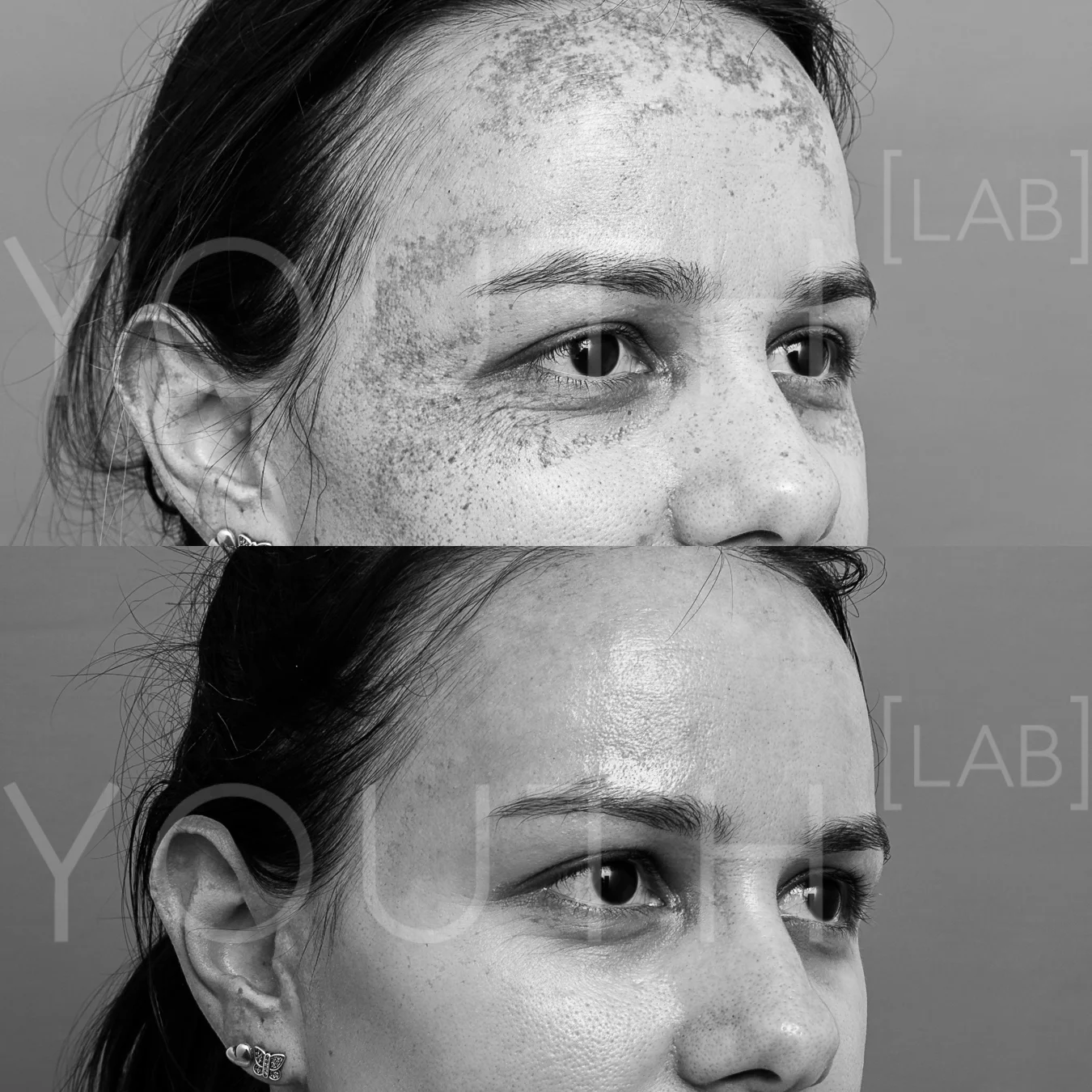 SF - dermamelan B&A (2).jpg
