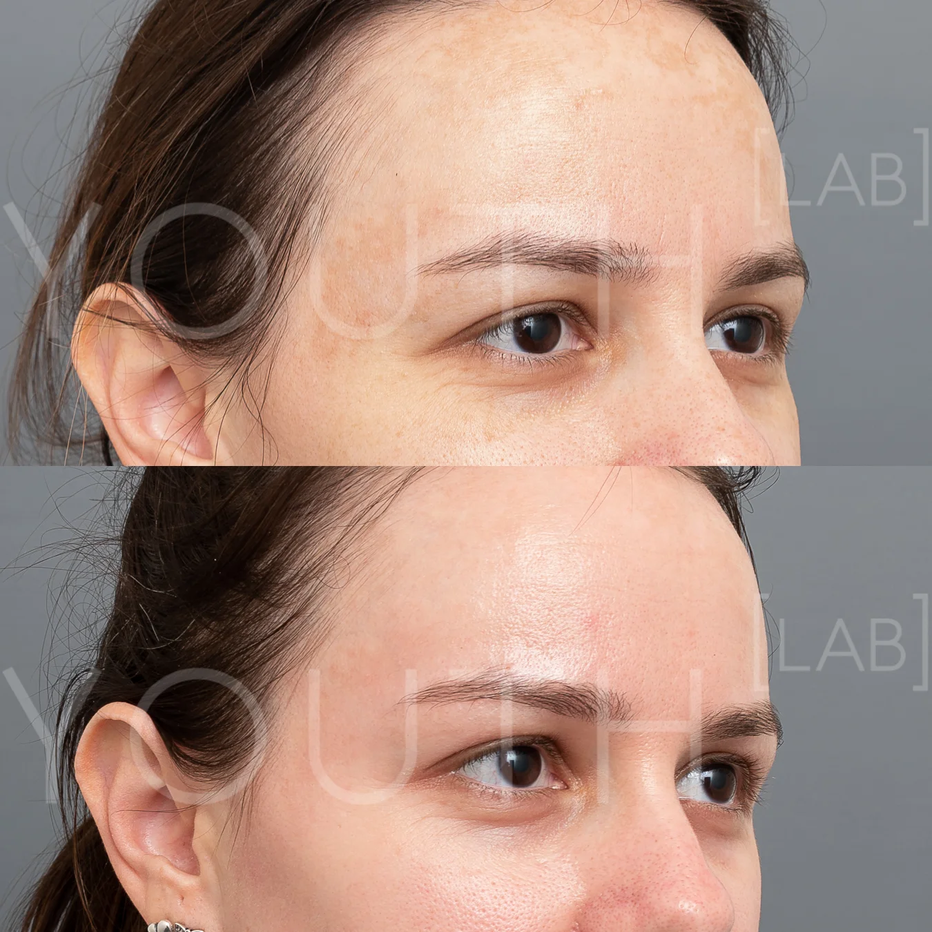 SF - dermamelan B&A (3).jpg