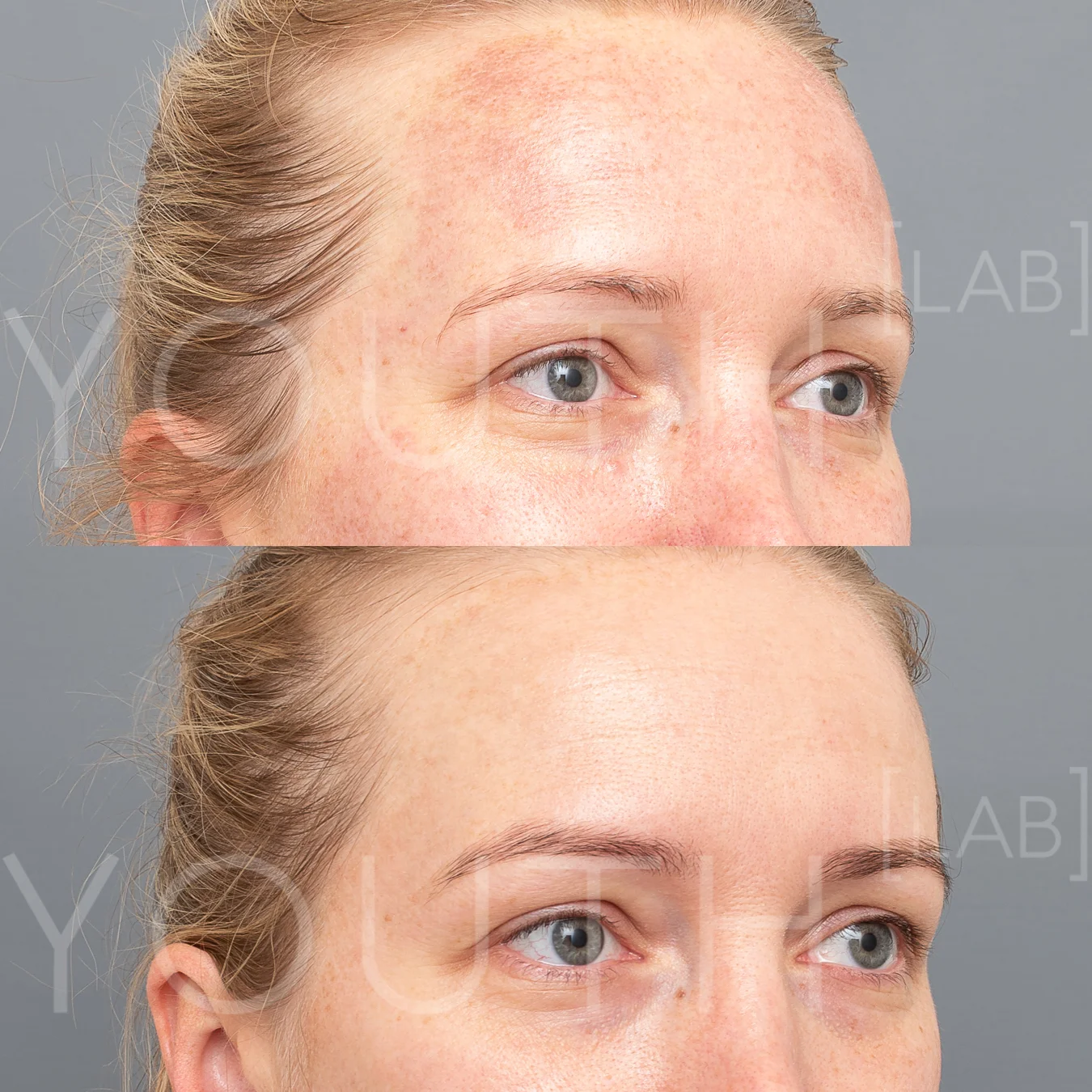 BP - BBL - 1 treatment.jpg