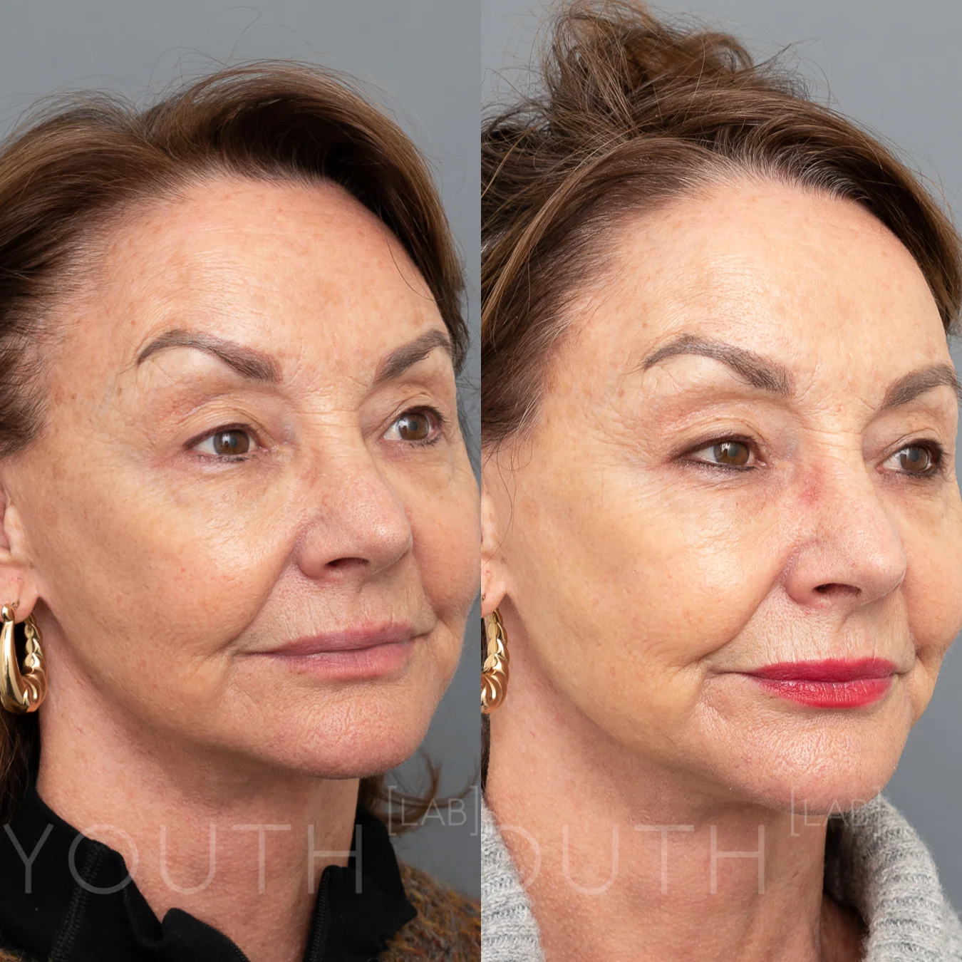 SP - BBL B&A one treatment.jpg