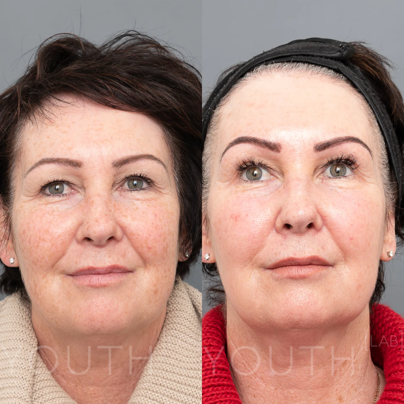YL-BBL-AH - BBL 2 treatments 2.jpg