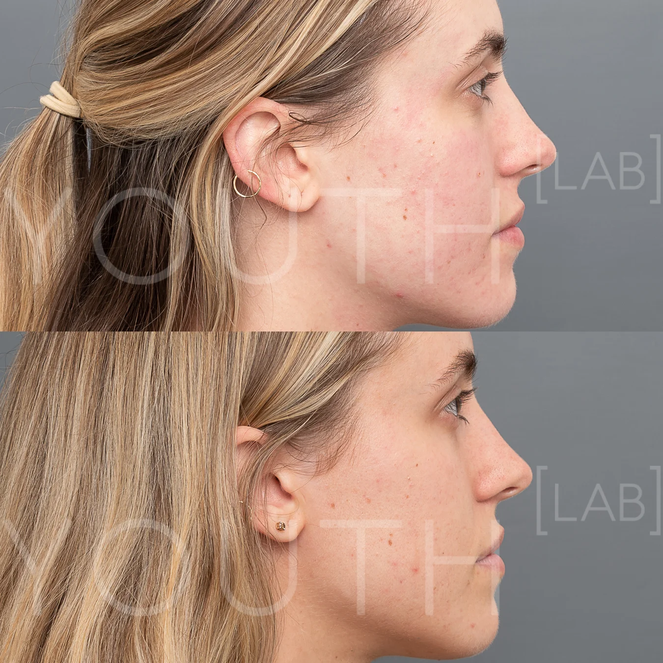 CT INTENSIF NEEDLING B&A 1.jpg