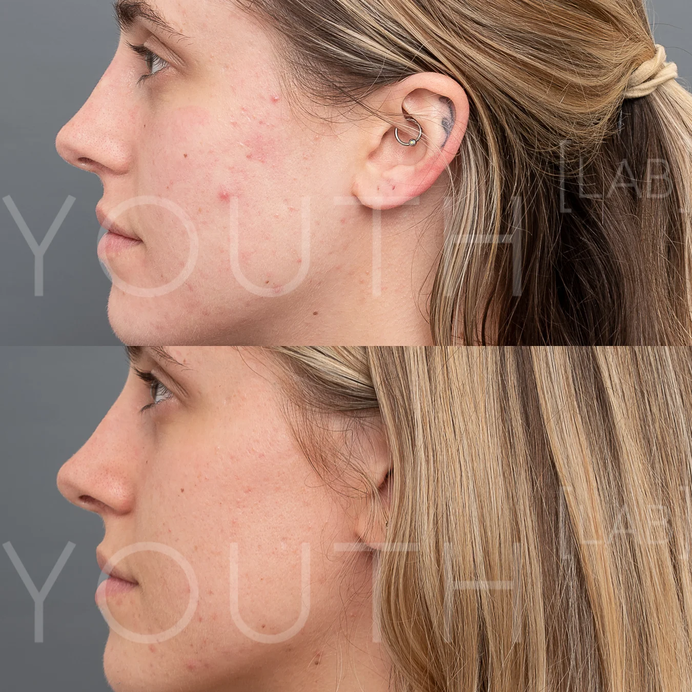 CT INTENSIF NEEDLING B&A 2.jpg