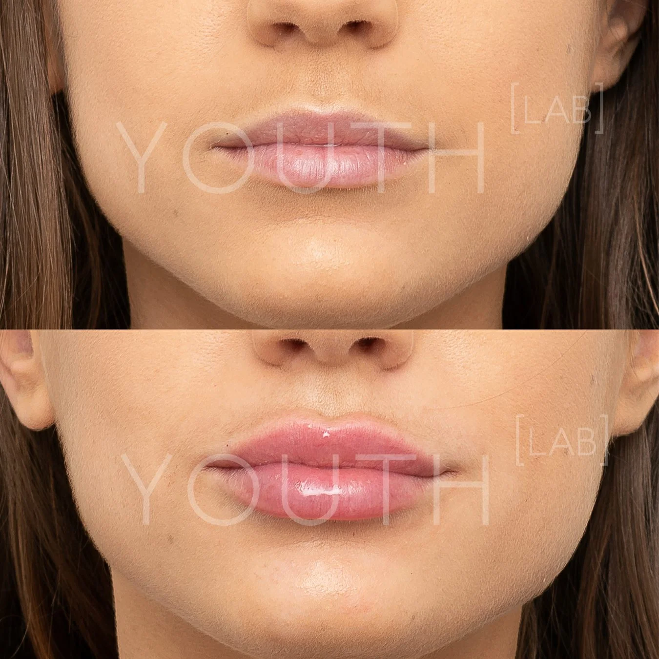 Consented - VA - lips B&A 3.jpg