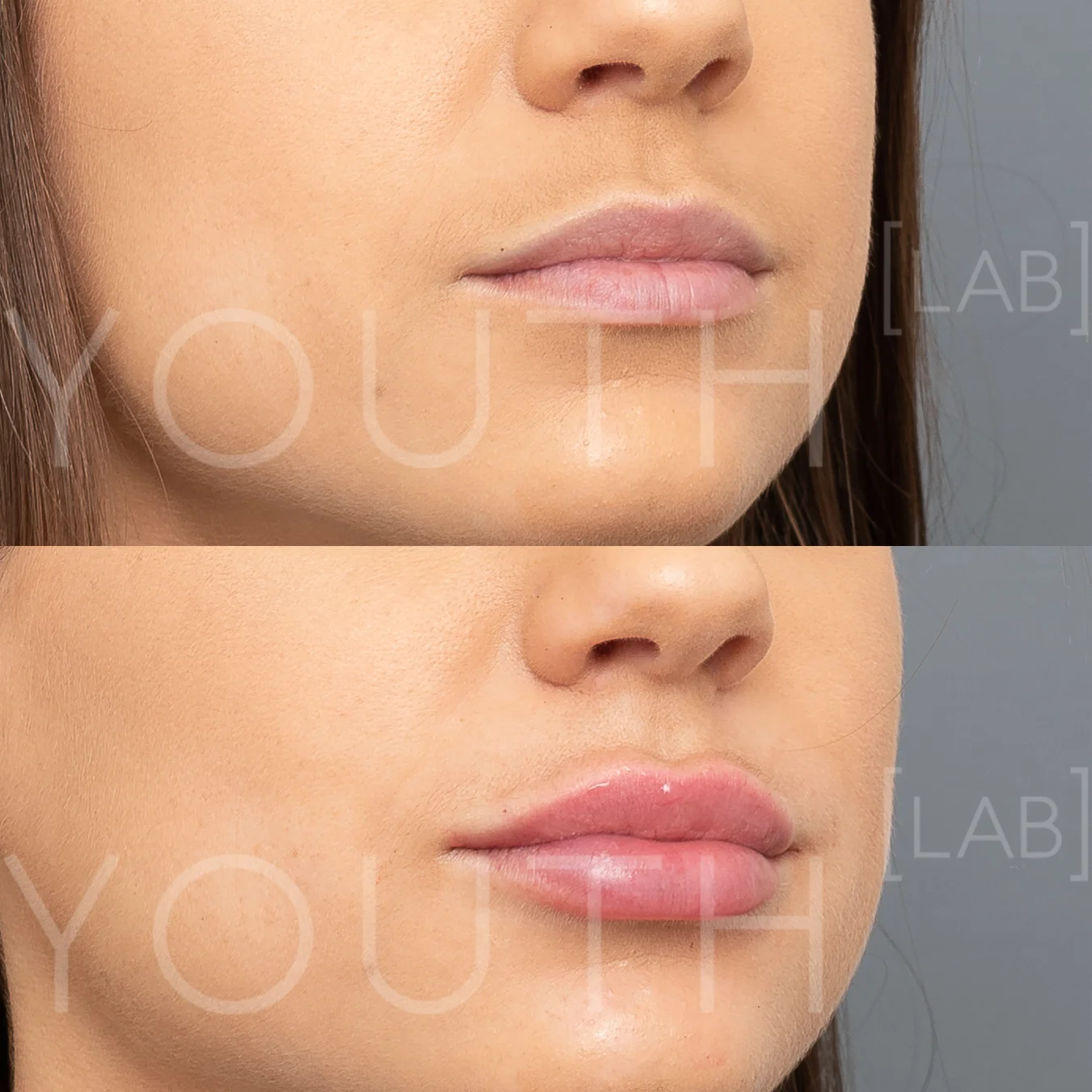 Consented - VA - lips B&A 1.jpg