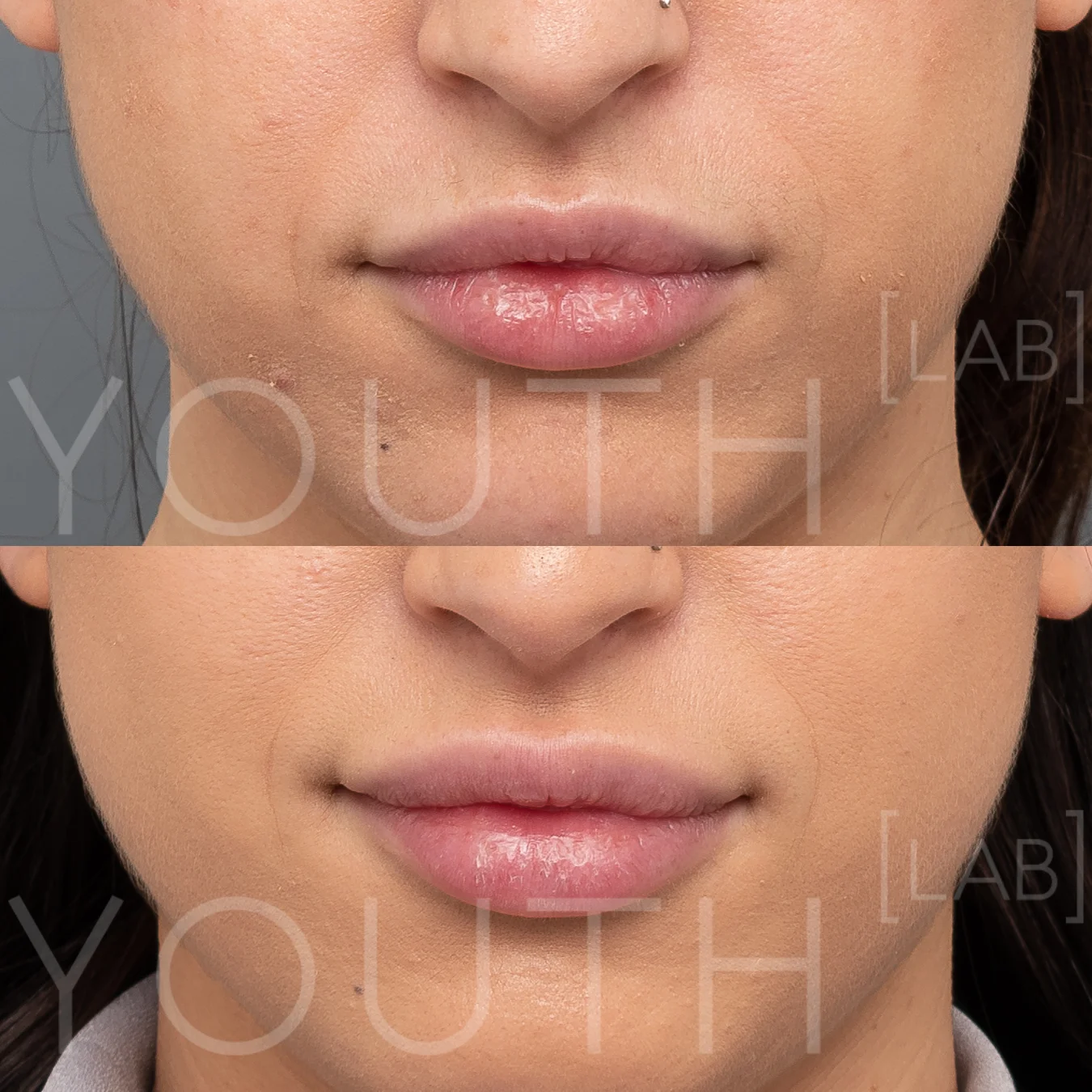 TK - Lips B&A 0 (1).5ml.jpg