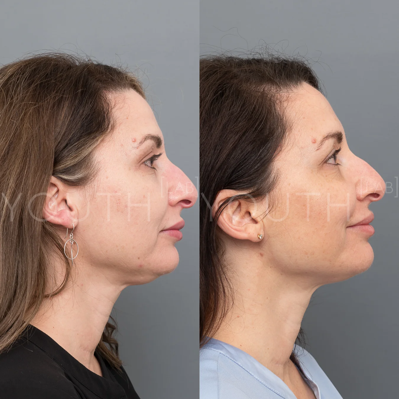 consented LF belkyra fillers KJ 1.jpg