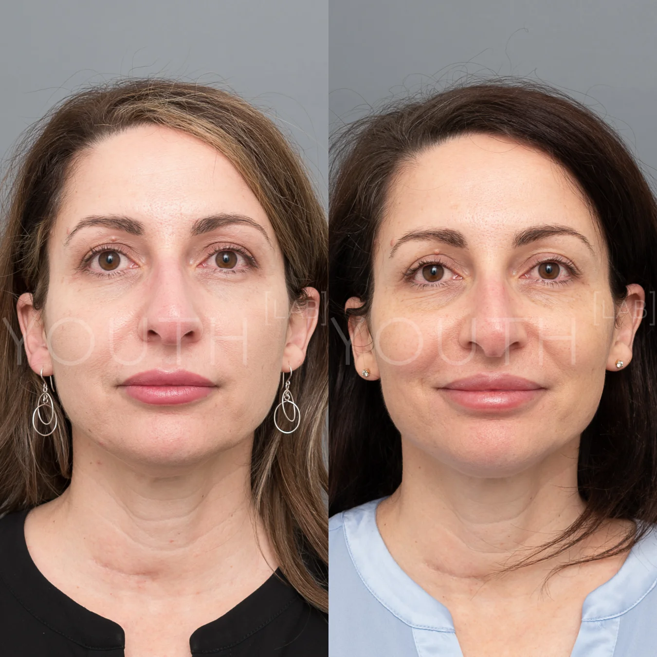consented LF belkyra fillers KJ 3.jpg