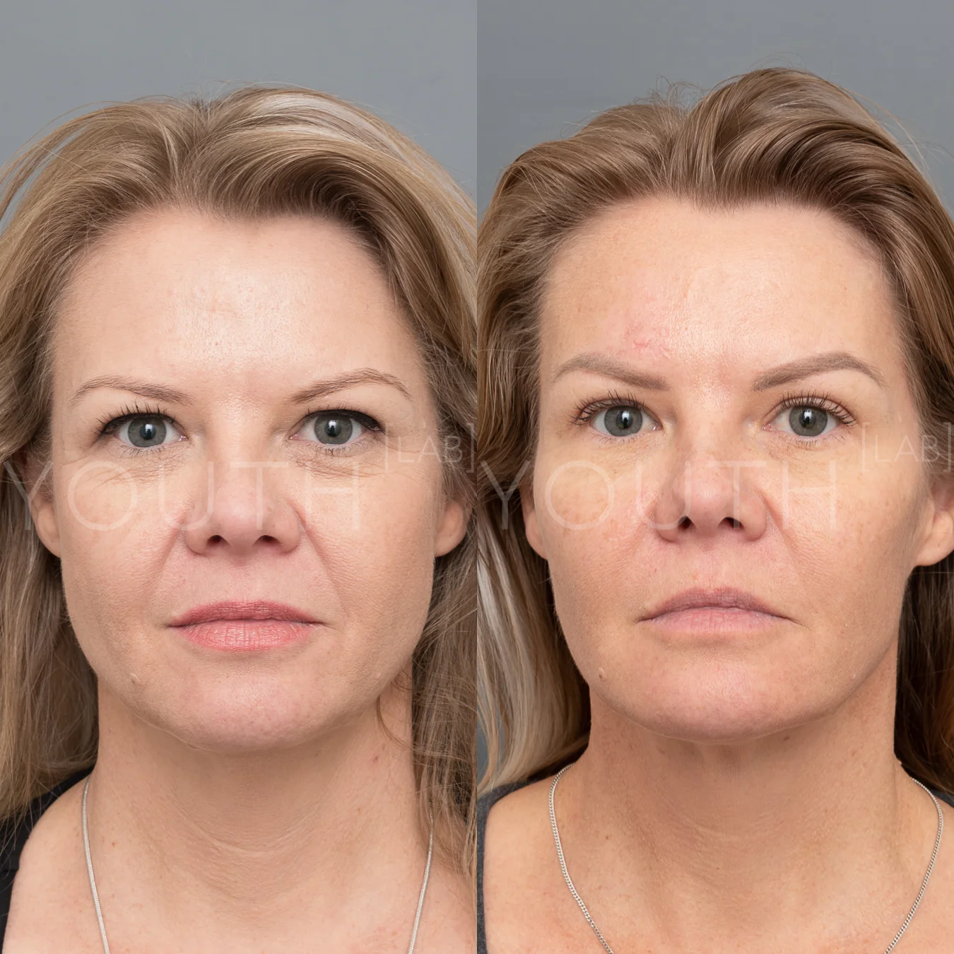 consented JP fillers midface aquagold KJ 2.jpg