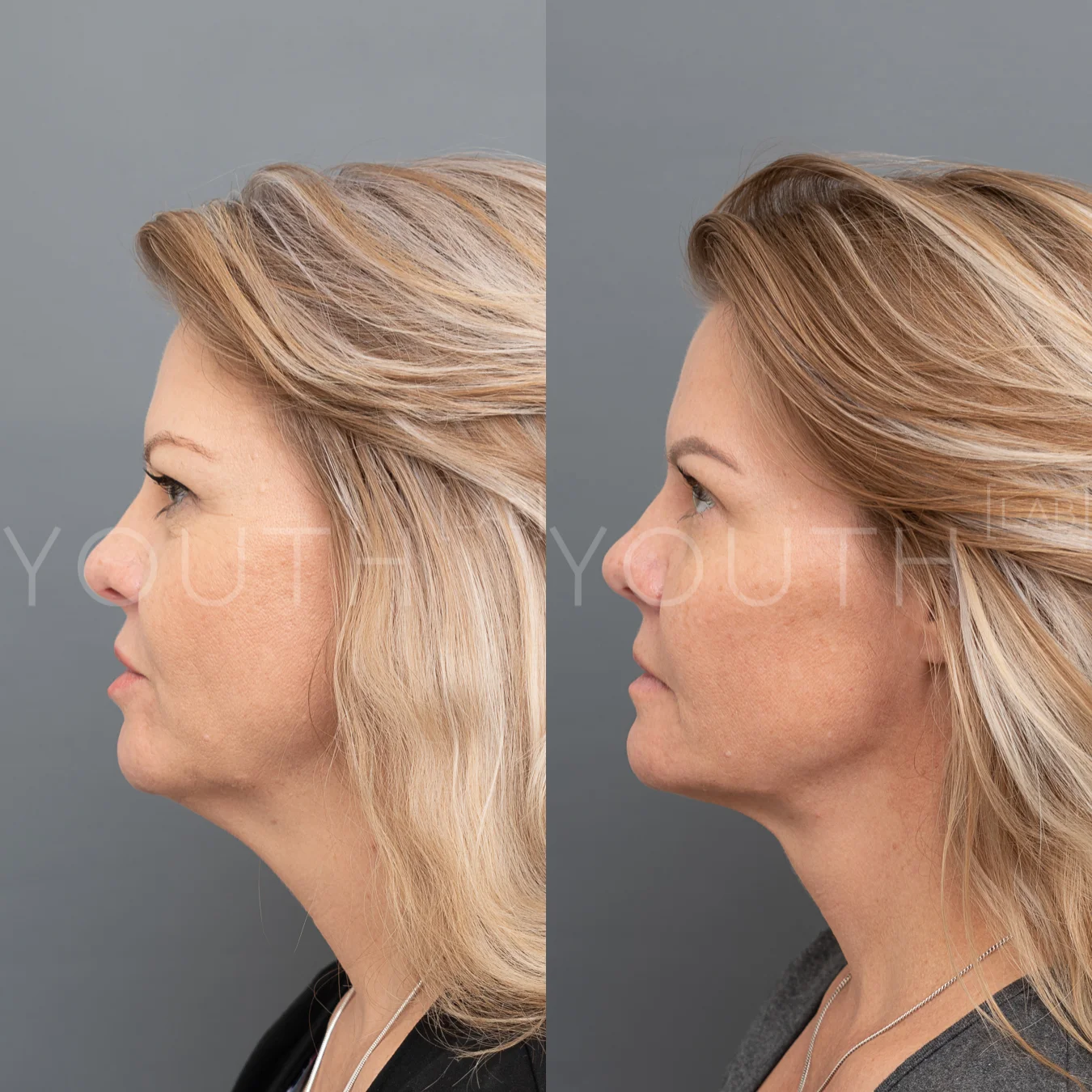 consented JP fillers midface aquagold fat dissolving KJ 3.jpg