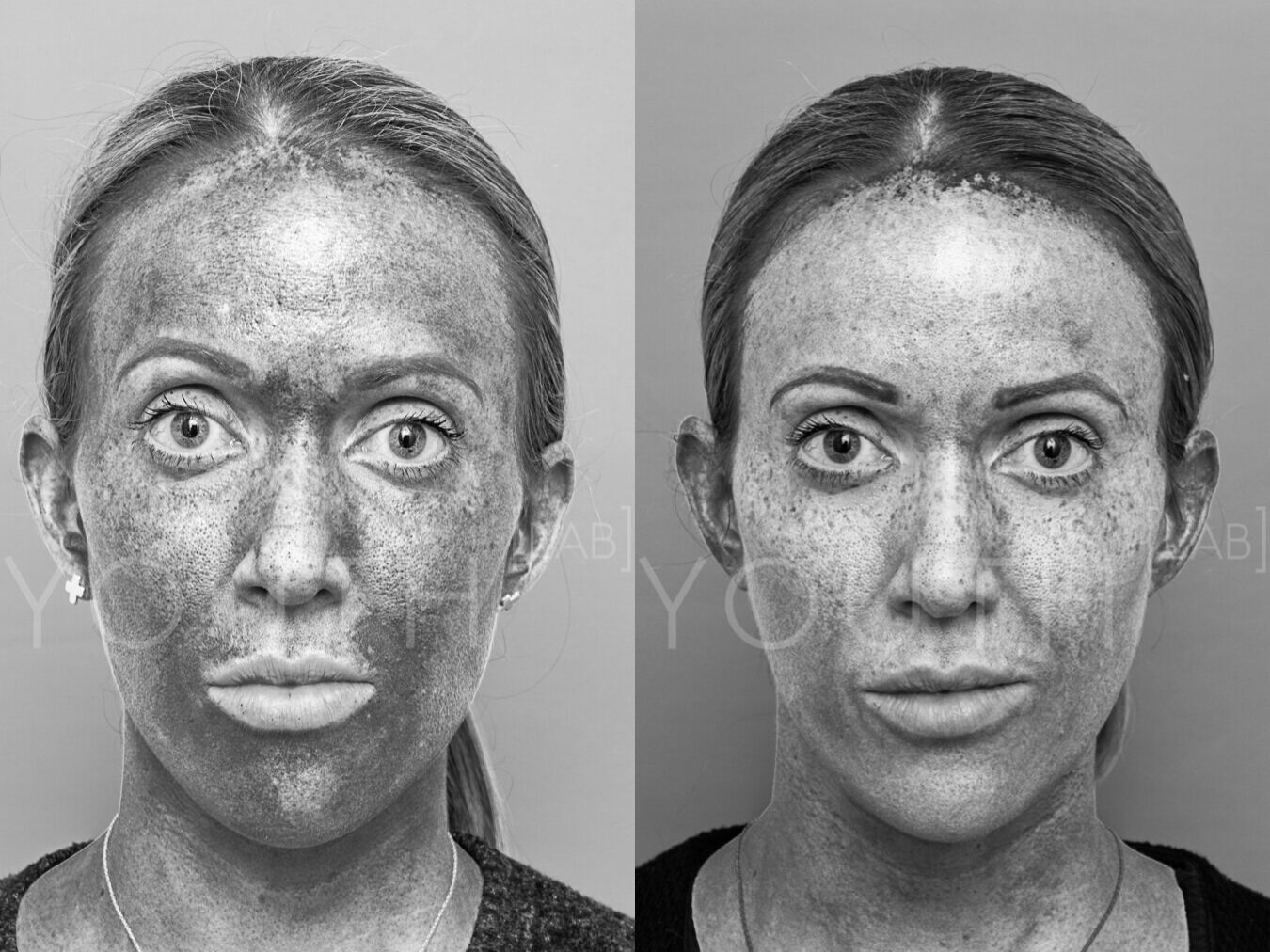 Consent+approved+-+Kate+J+-+BBL+-+2+treatments+-+AM+%282%29.jpg