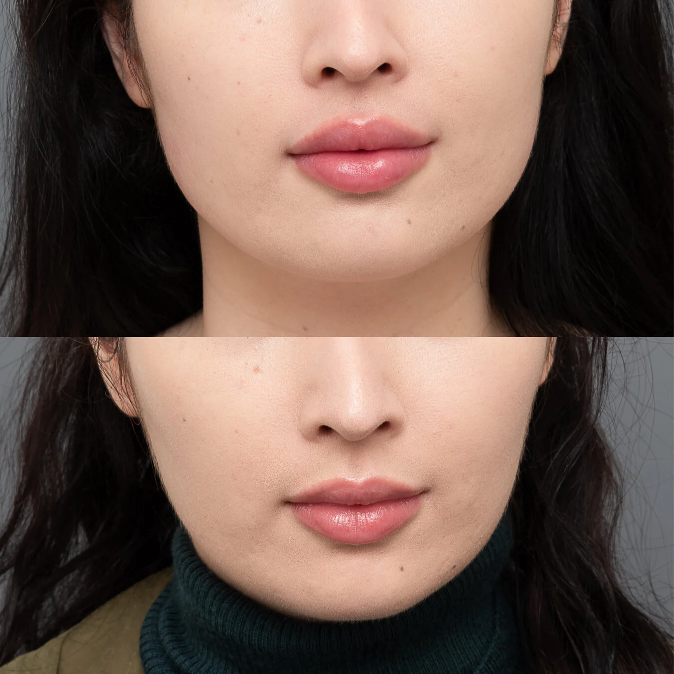 consented - IT masseters 8 weeks KJ 2.jpg