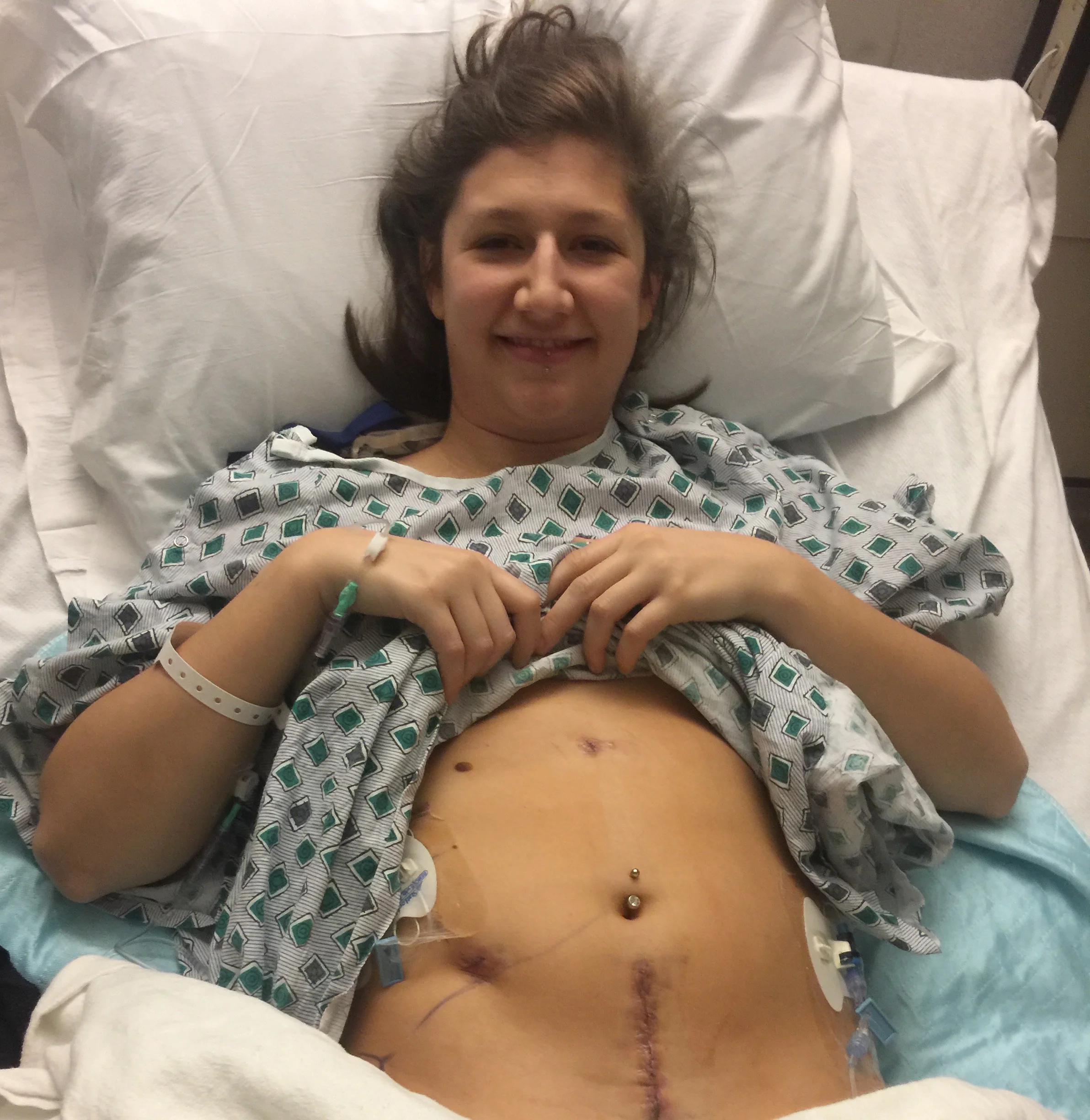 Kirsten, showing off her incision four hours after surgery.