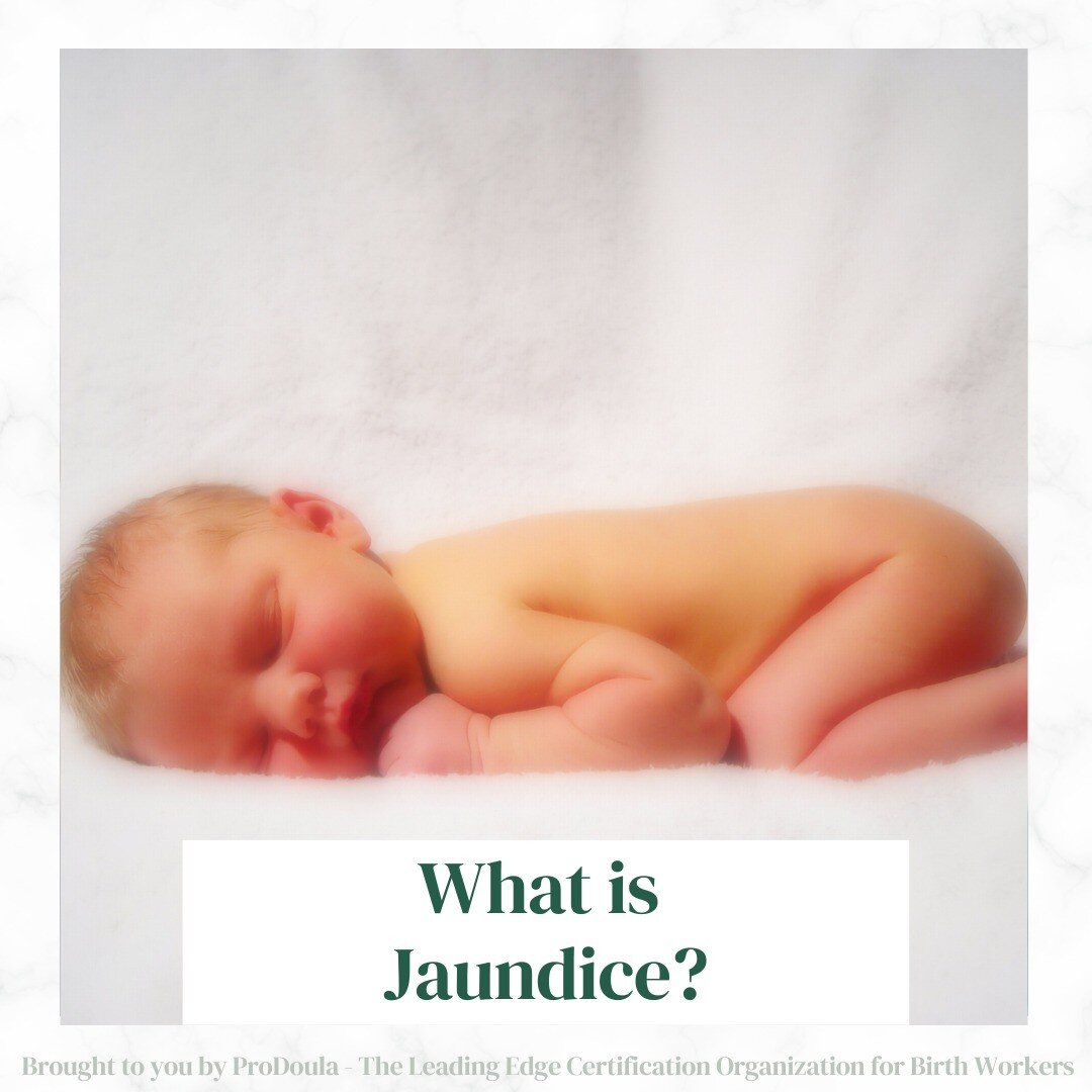 𝐖𝐡𝐚𝐭 𝐢𝐬 𝐉𝐚𝐮𝐧𝐝𝐢𝐜𝐞?

▶Jaundice is the yellowing of the eyes and/or the skin due to the buildup of bilirubin in the baby&rsquo;s liver. A slight yellowing of the baby&rsquo;s skin is normal after birth and typically peaks around day 3 or 4