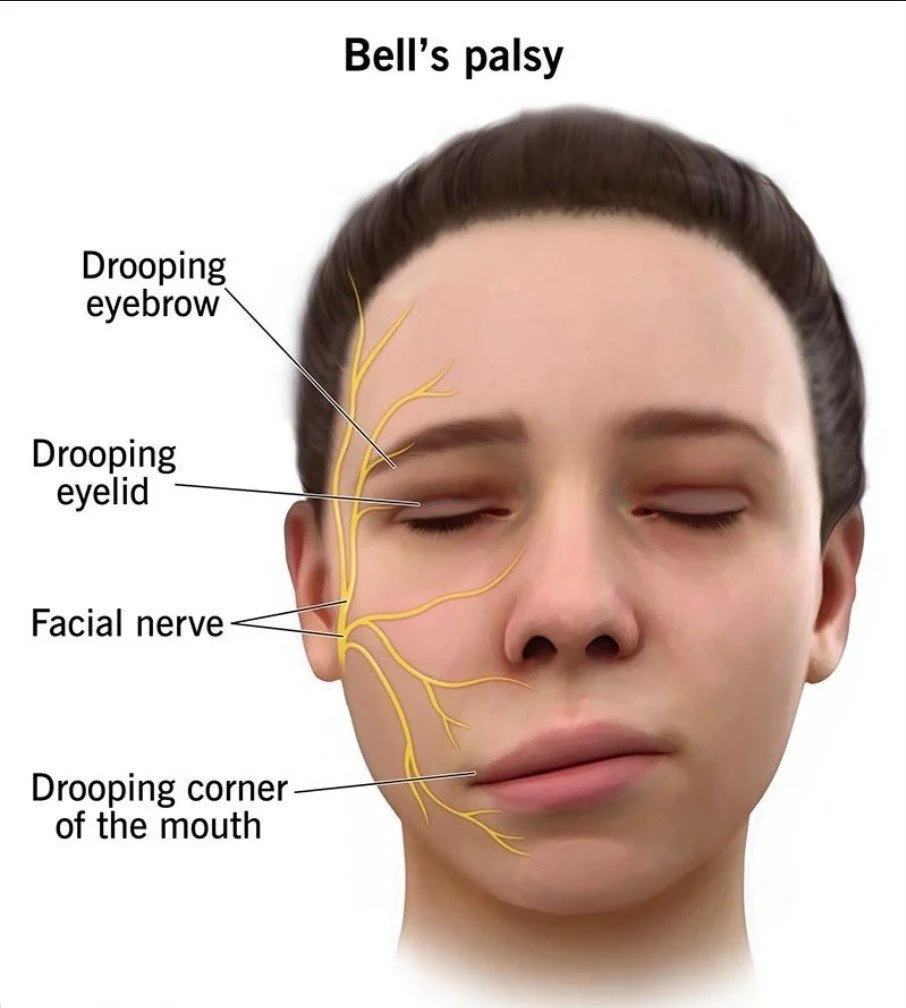 Bell's Palsy Shot - $95