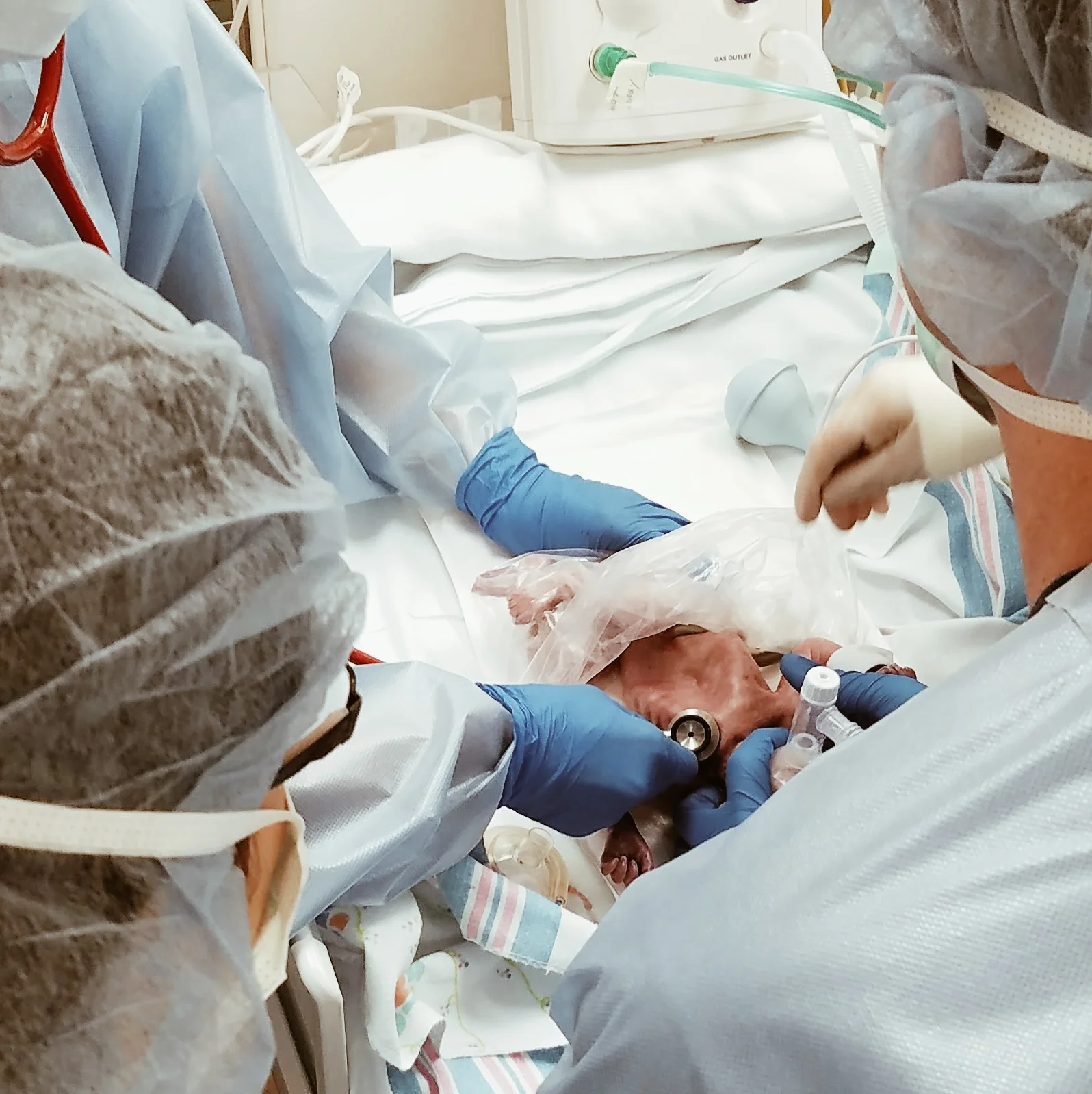 Samuel's chest was so collapsed due to his underdeveloped lungs
