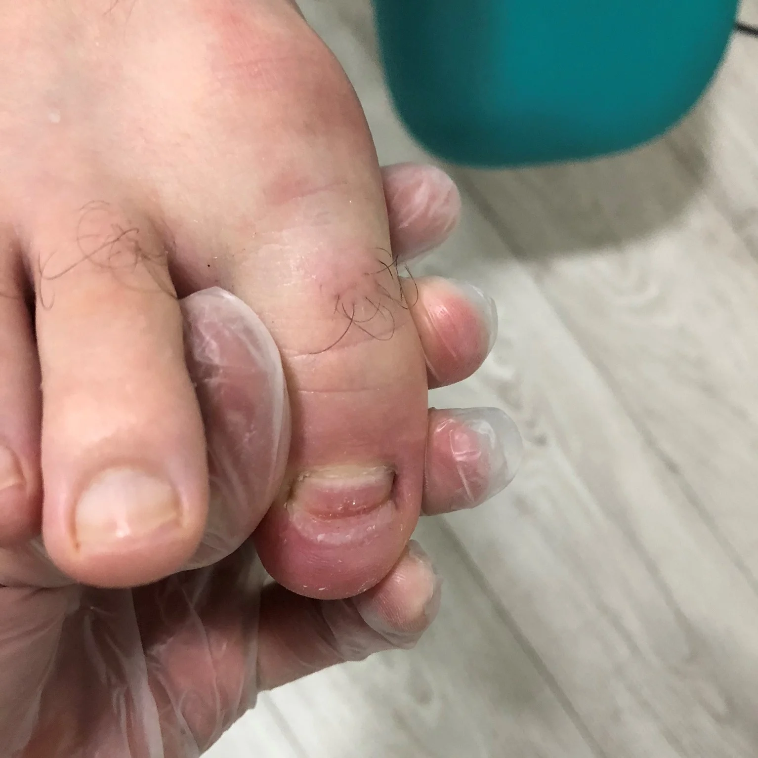 Ongle Bleu Lhématome Sous Unguéal Pédicure Podologue