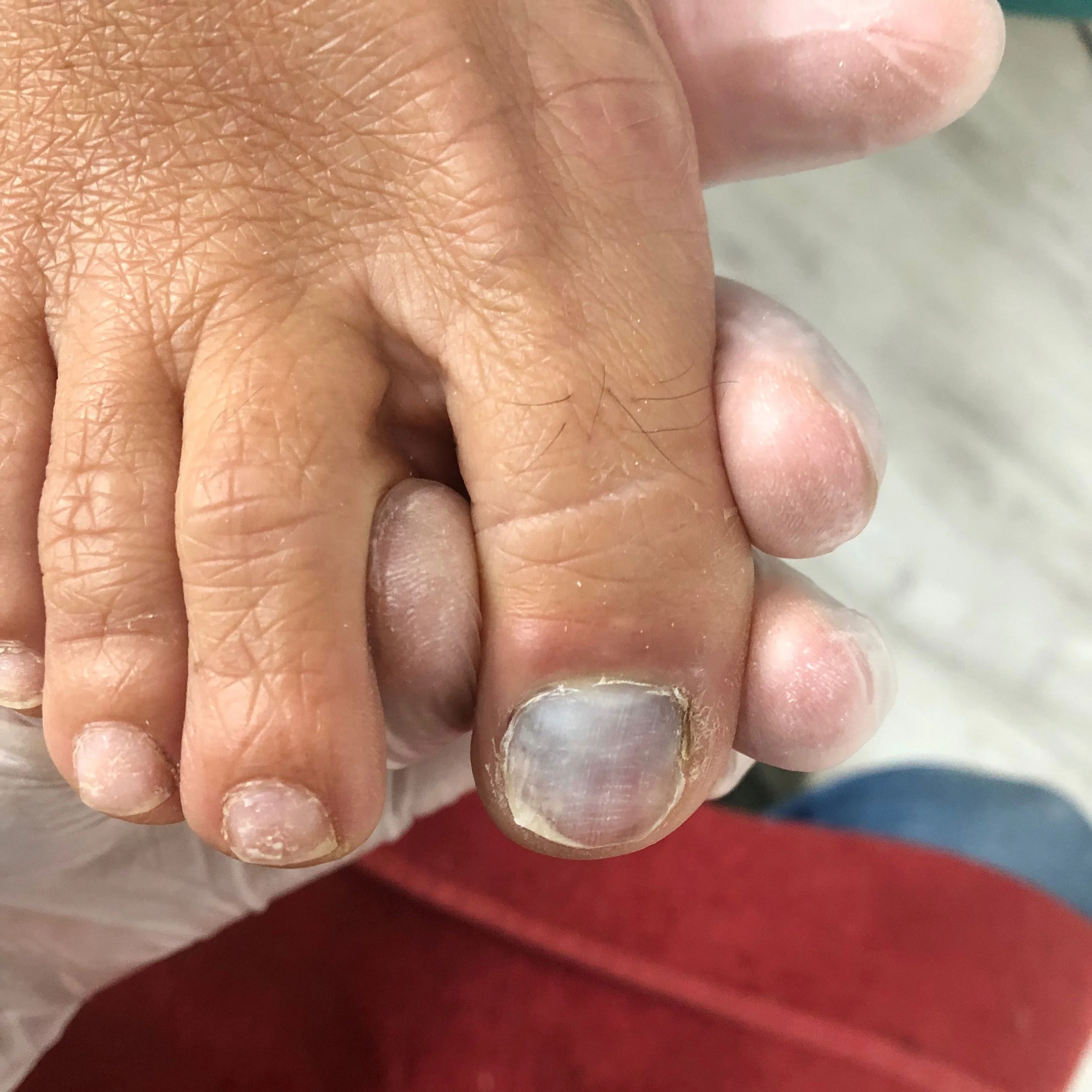 L'hématome sous-unguéal et le vernis permanent.