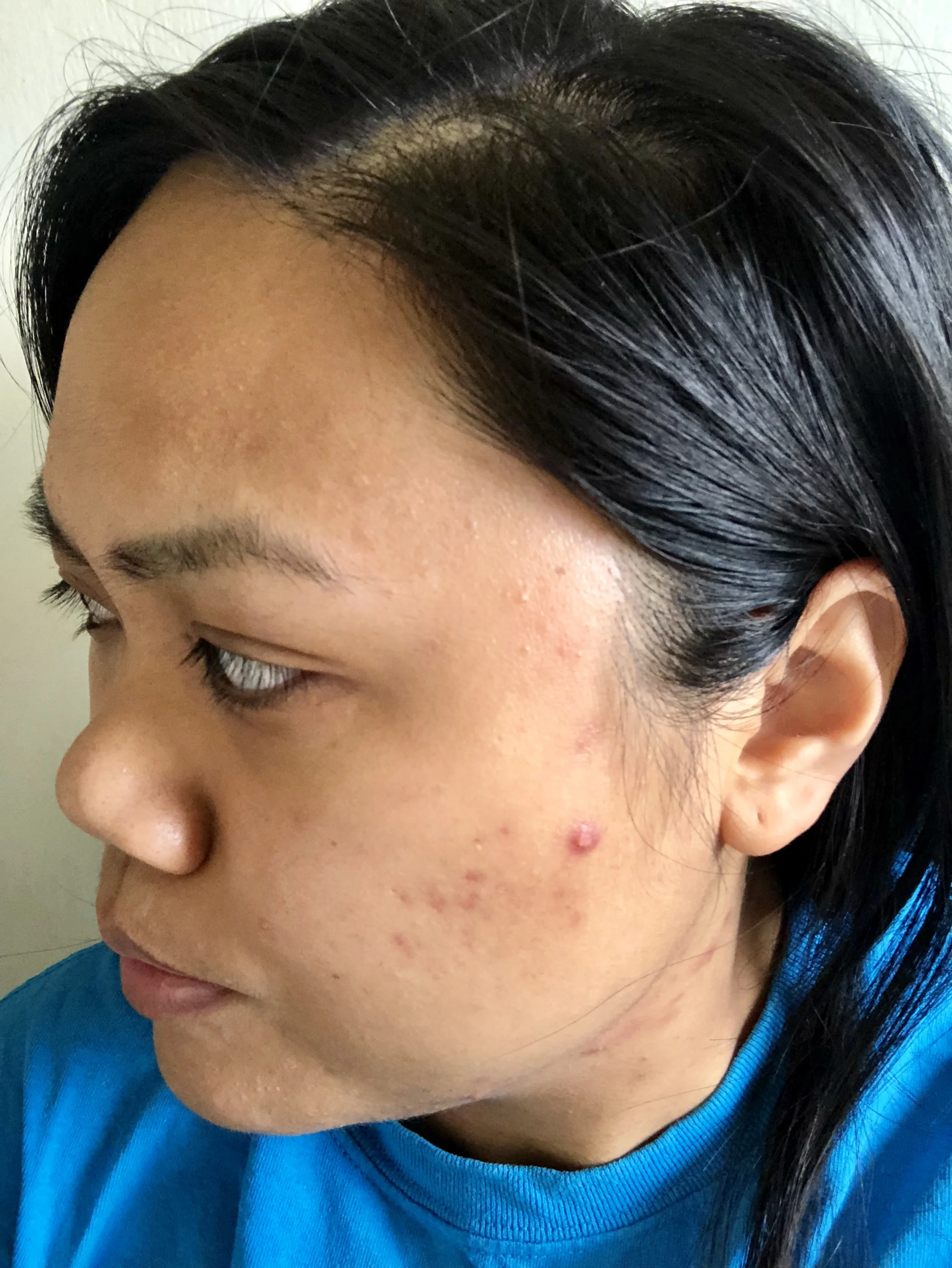 My left side is a problem area for me, but my acne scars are beginning to fade. Ignore the new pimple that decided to pop up this week!
