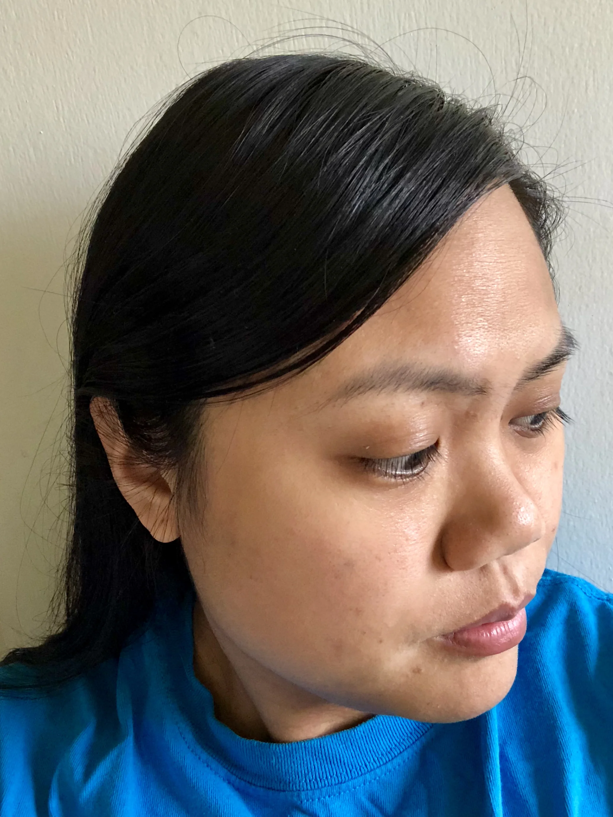 My right side looks significantly clearer!