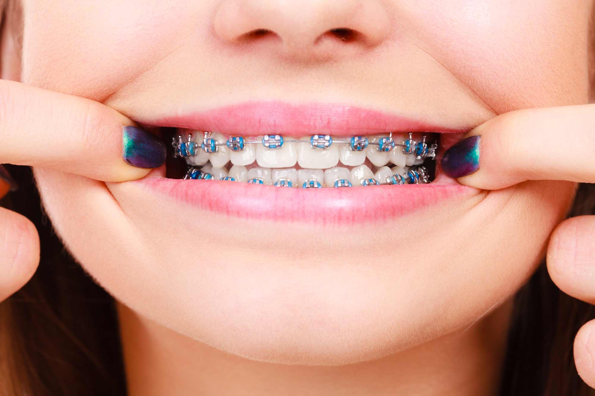 Braces are available for all age groups, from children right through to adults