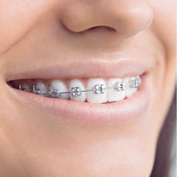 Braces-03.png