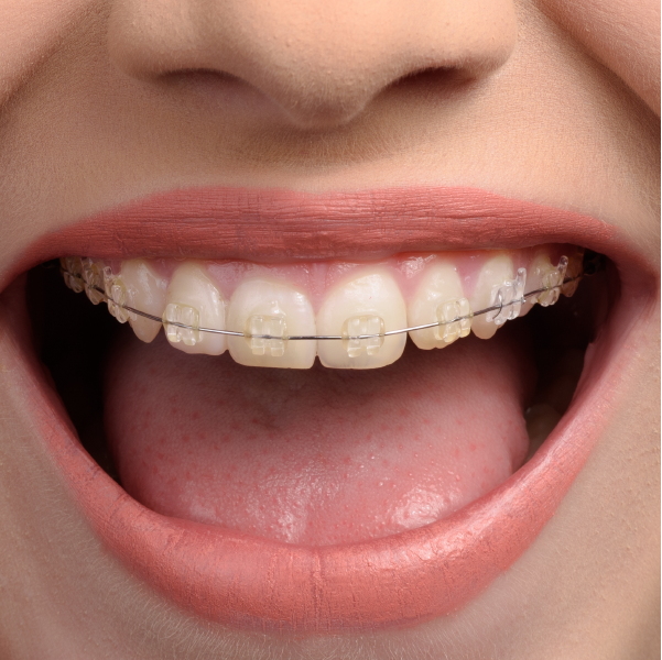 Braces-02.png