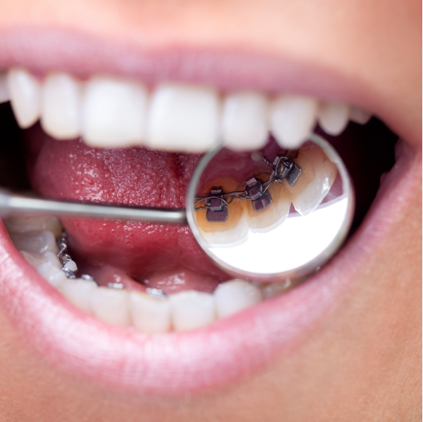 Braces-04.png