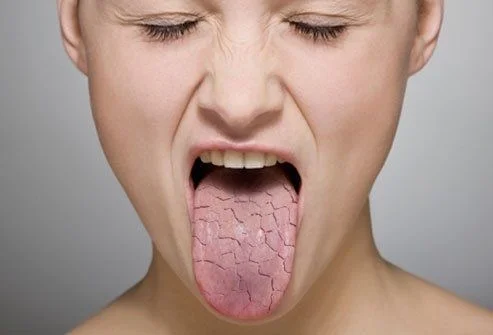 Dry Mouth