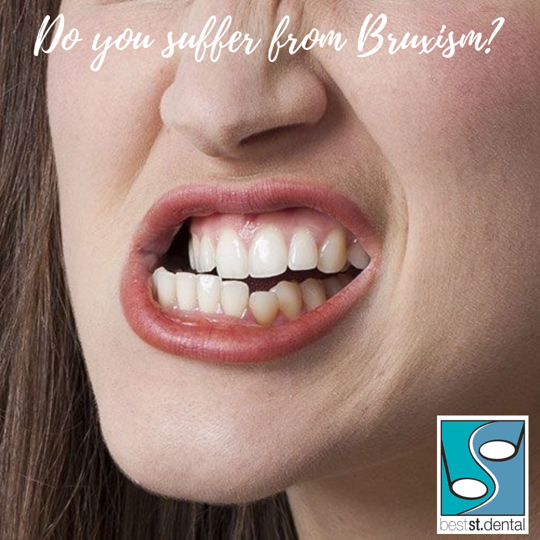 Signs of tooth grinding and why you need to know them