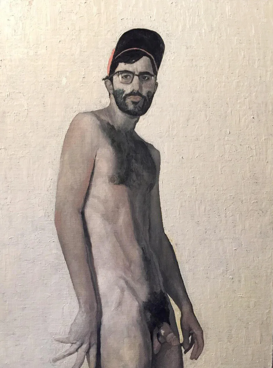 Vitiligo
