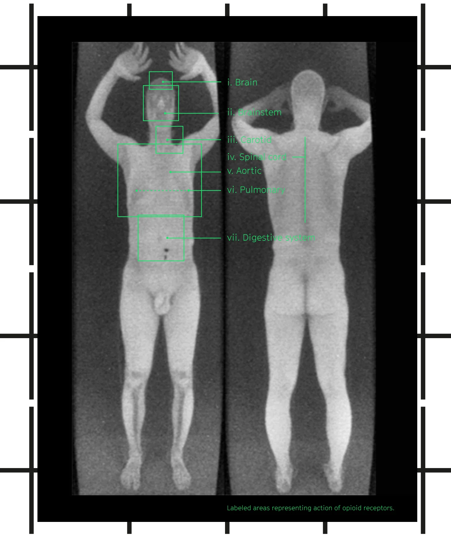 Areas representing action of opioid receptors. Scan credit: Radsec.org