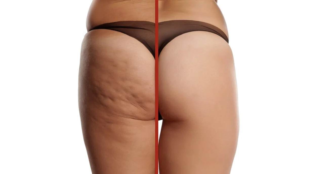 I migliori trattamenti per la cellulite del 2021