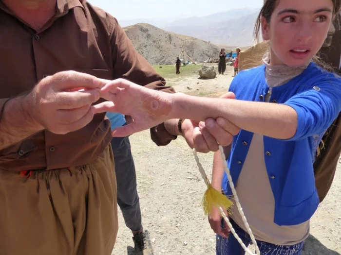 Young female in the Alana Gully with shrapnel in her wrist from Iranian shelling. June, 2016. Photo by: Julie Brown.