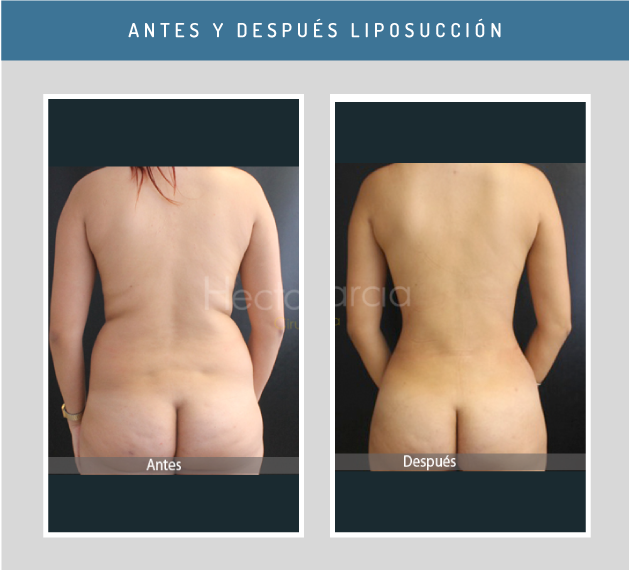 Antes-y-Después8.png