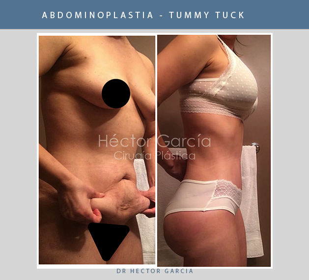 abdominoplastiacolombia.jpg