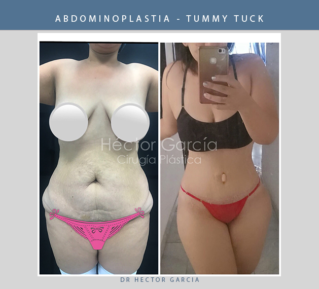 abdominoplastiabucaramanga.jpg