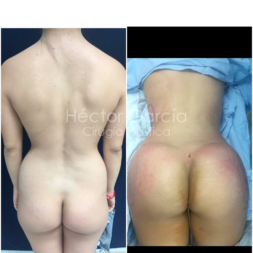 Copia de lipotransferencia2.jpg