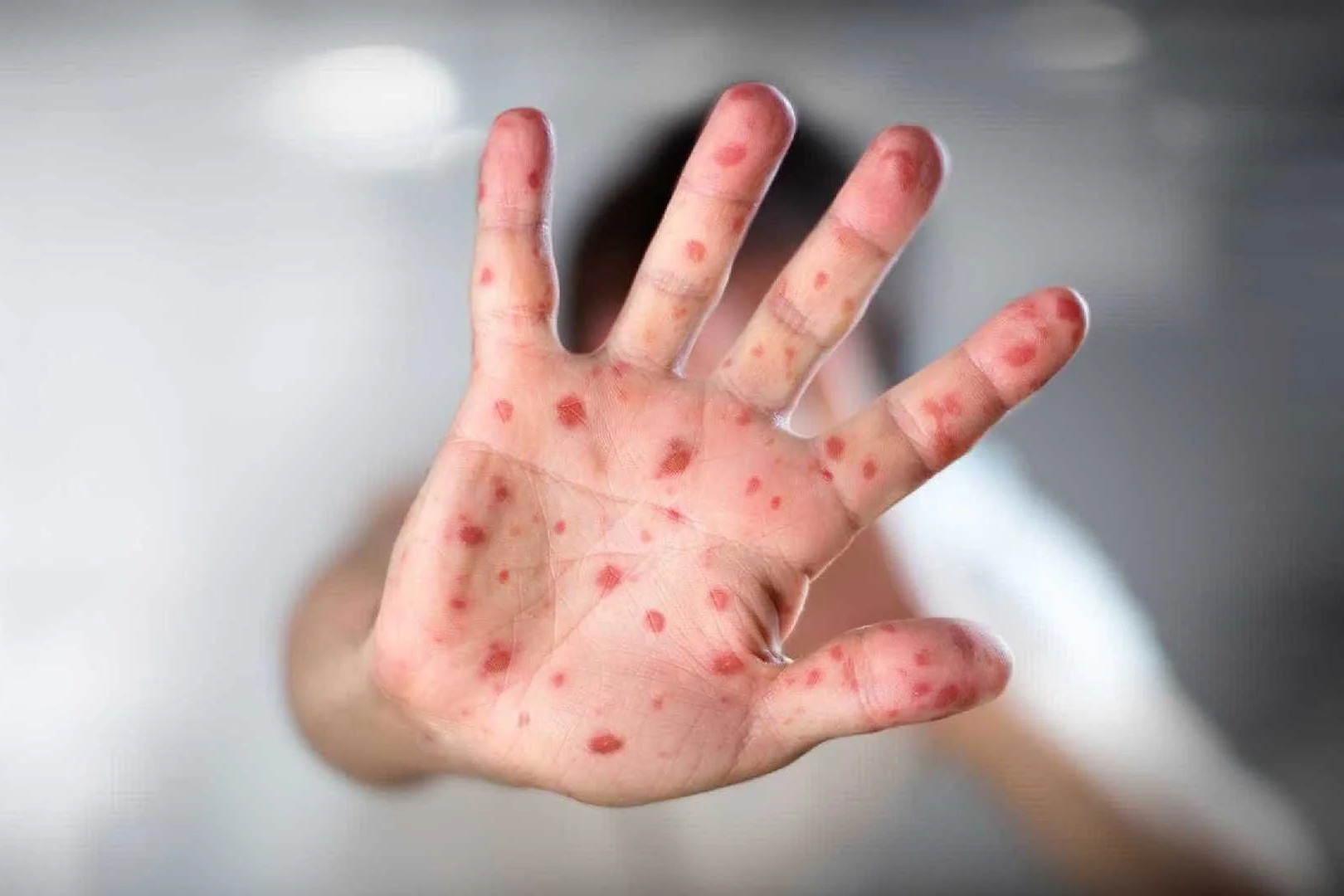 Sintomas do sarampo incluem manchas vermelhas no corpo.