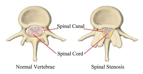 You can see the right spinal canal has a lot less space which means all the structures trying to go through it will be affected!